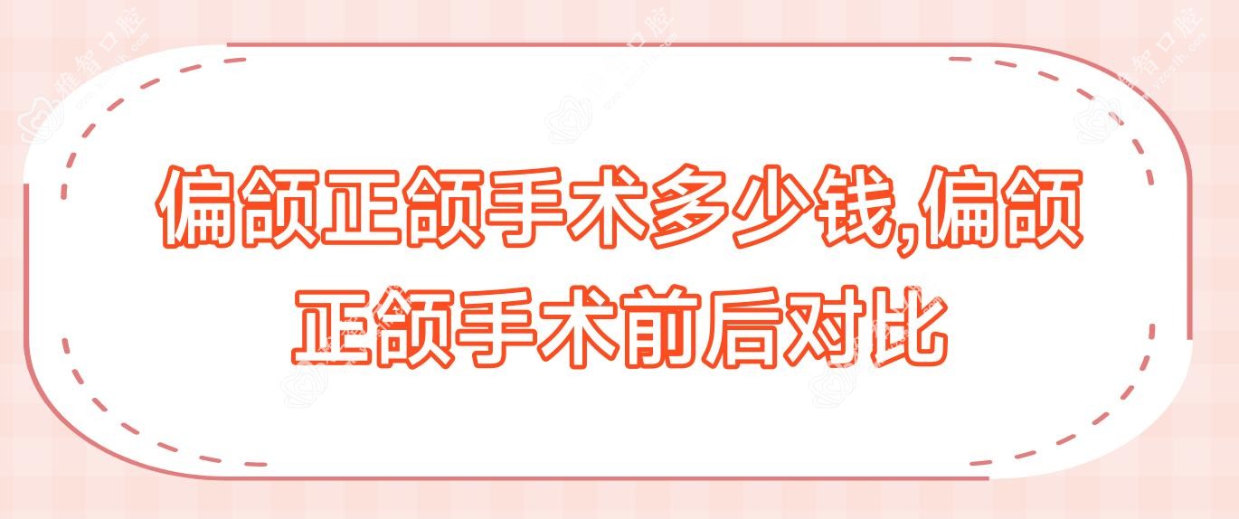 偏颌正颌手术多少钱,偏颌正颌手术前后对比