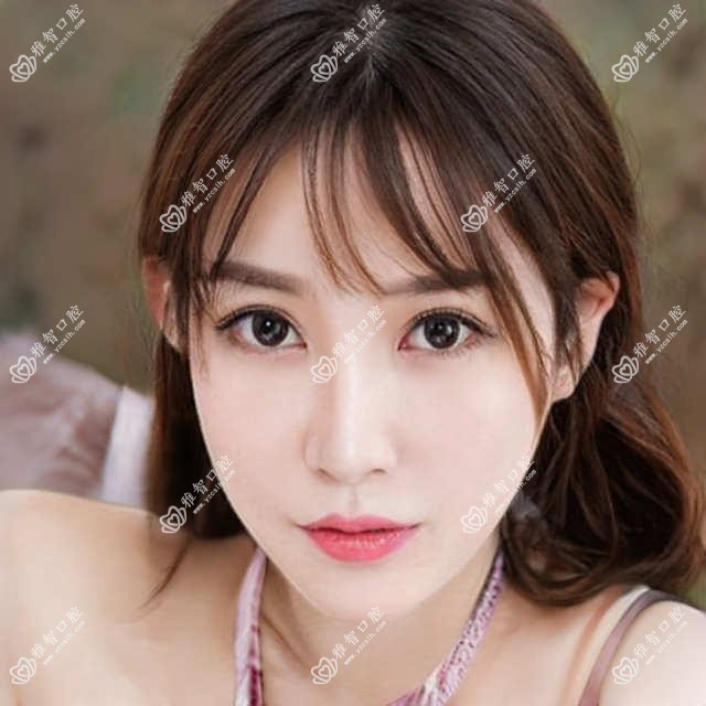 苏州深覆盖正颌手术是多少?脸型不对称正颌手术150000元左右