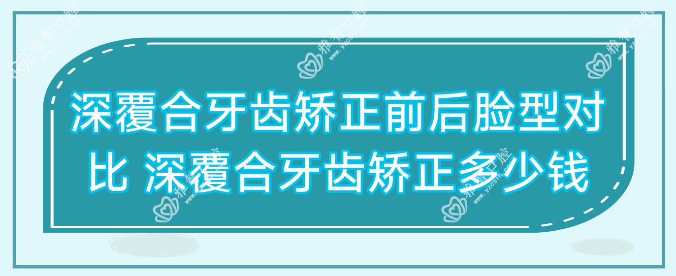 深覆合牙齿矫正前后脸型对比 深覆合牙齿矫正多少钱