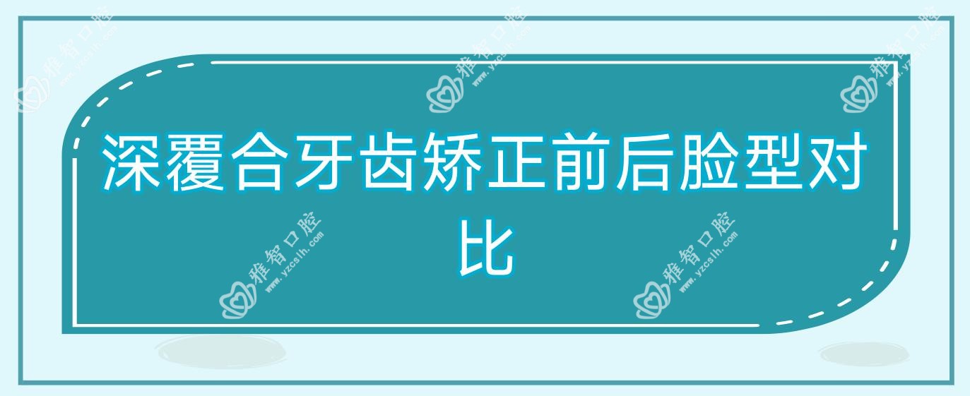 深覆合牙齿矫正前后脸型对比