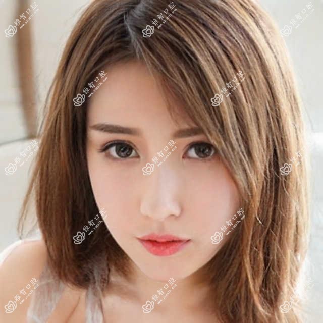 舌侧矫正指南?舌侧矫正好转方法详解?