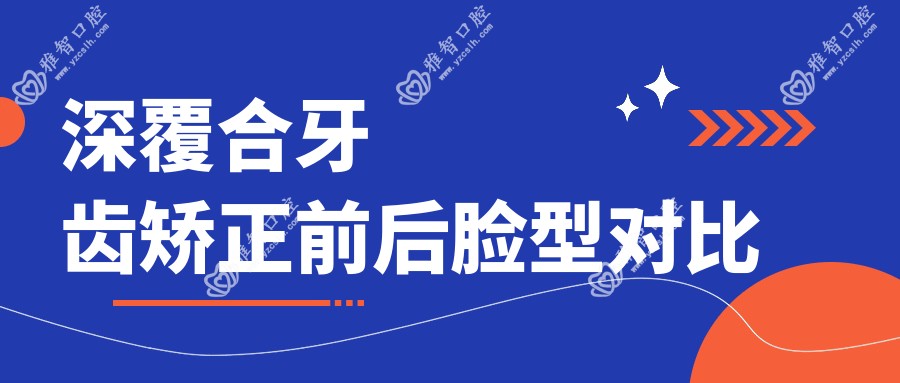 深覆合牙齿矫正前后脸型对比