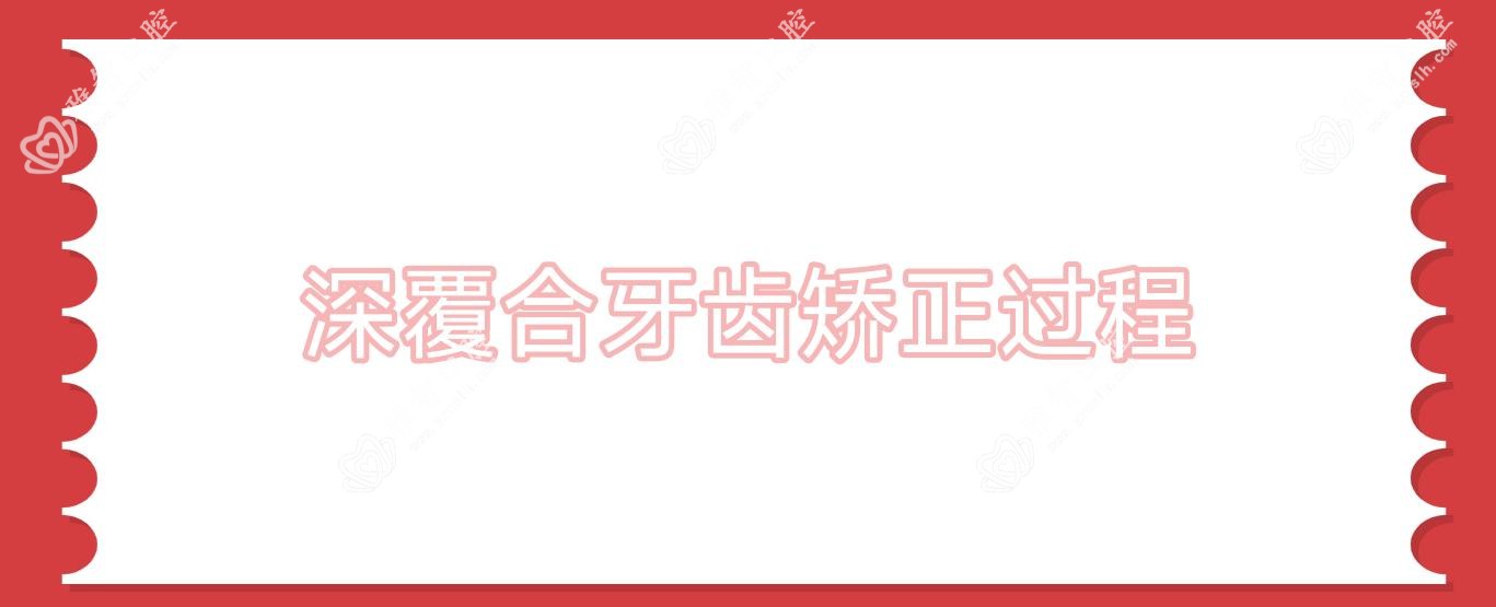 深覆合牙齿矫正过程