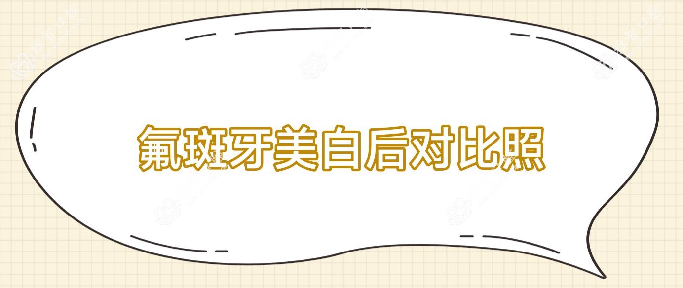 氟斑牙美白后对比照