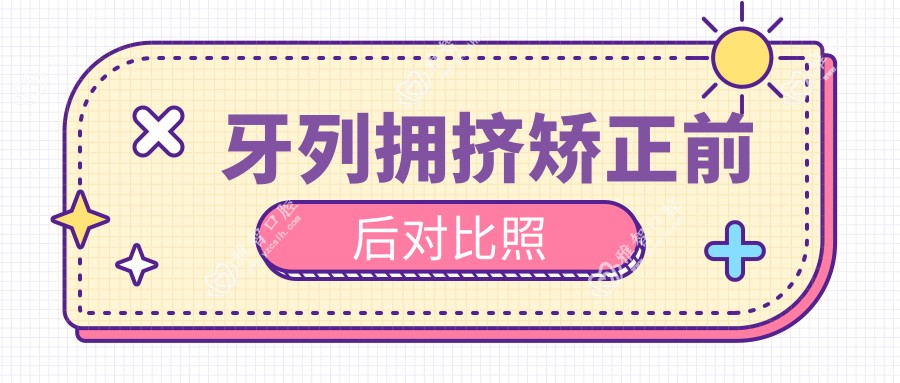 牙列拥挤矫正前后对比照