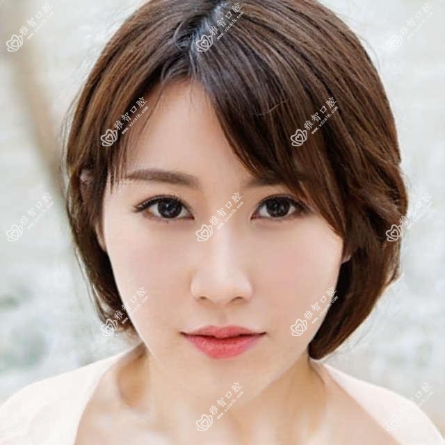 广州牙间隙矫正大概需要多少钱?广州金属托槽矫正/牙列拥挤矫正/半隐型矫正收费有性价比
