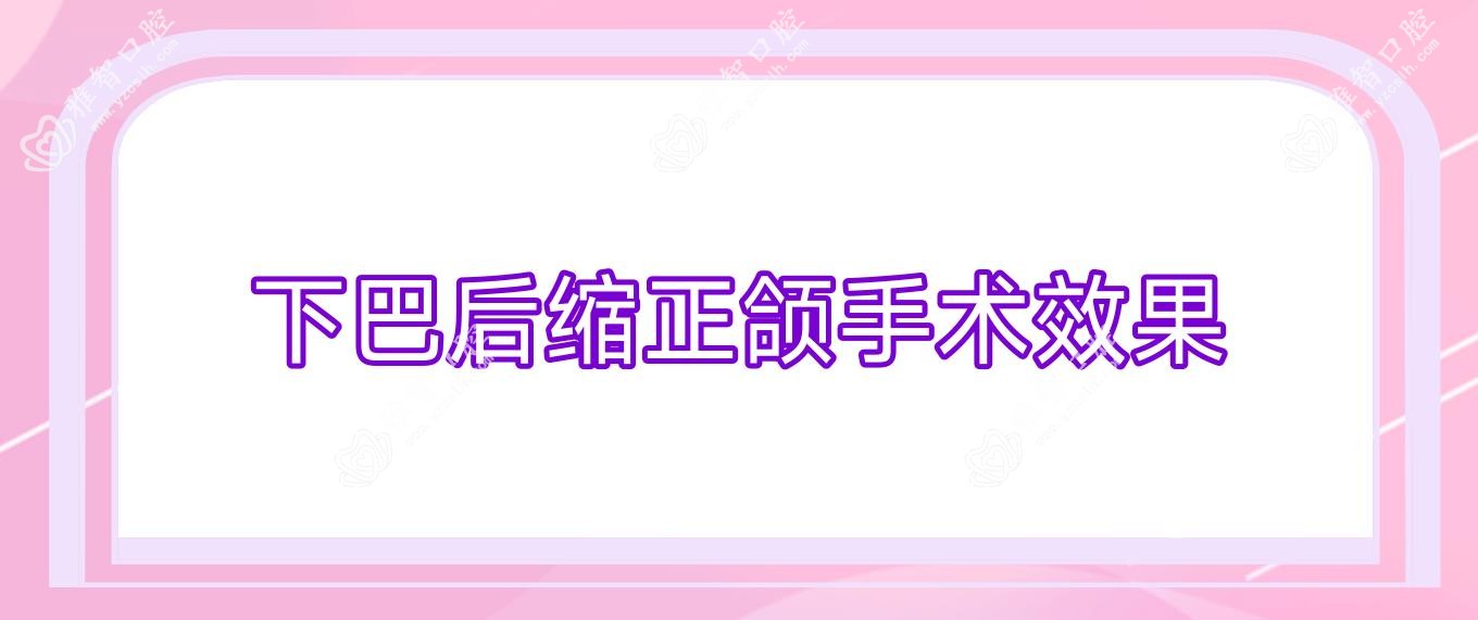 下巴后缩正颌手术疗效