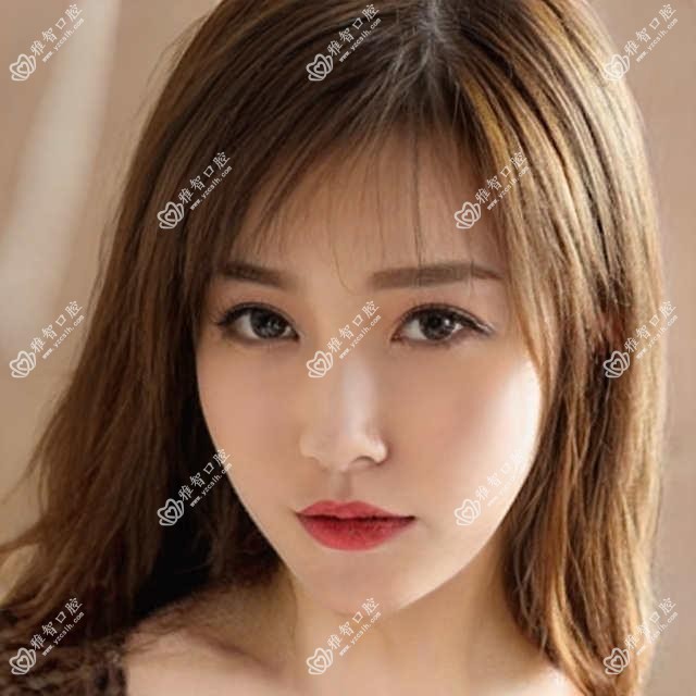 绍兴瓷贴面费用2025年新具体揭晓-雅欣口腔·牙齿矫正/绍兴王国海口腔瓷贴面价格表(收费)