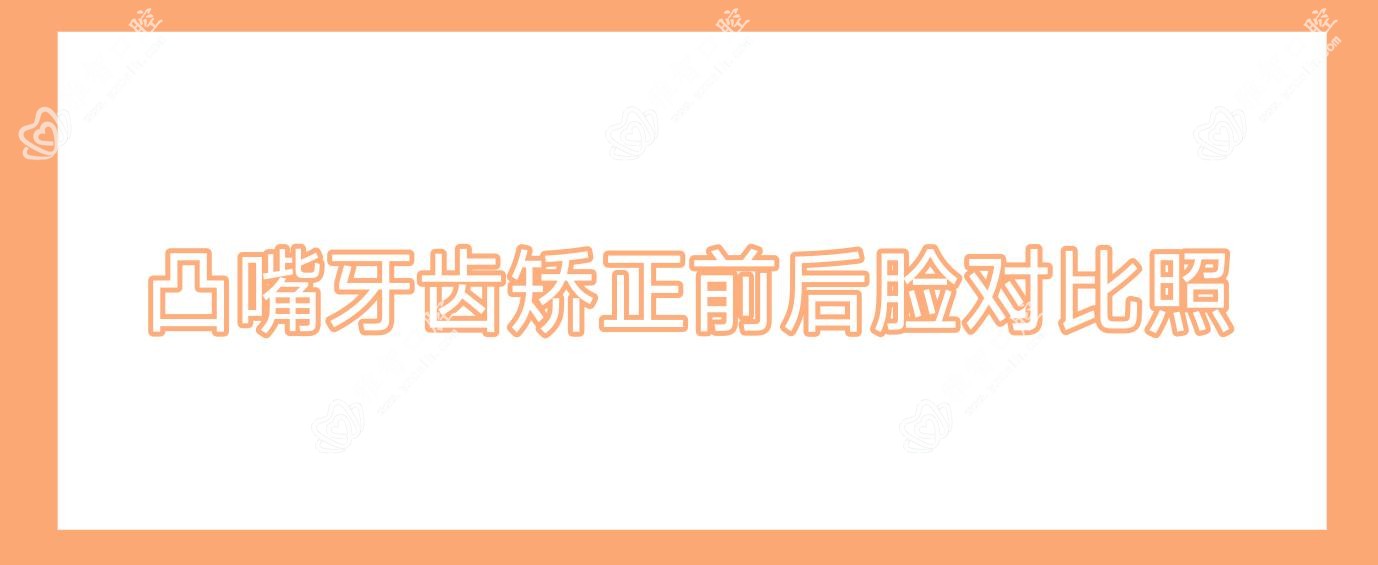 凸嘴牙齿矫正前后脸对比照