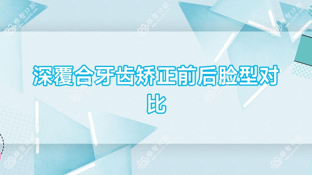 深覆合牙齿矫正前后脸型对比