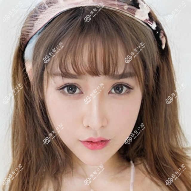 昆明氟斑牙美白多少钱?美国皓齿美白2200元左右