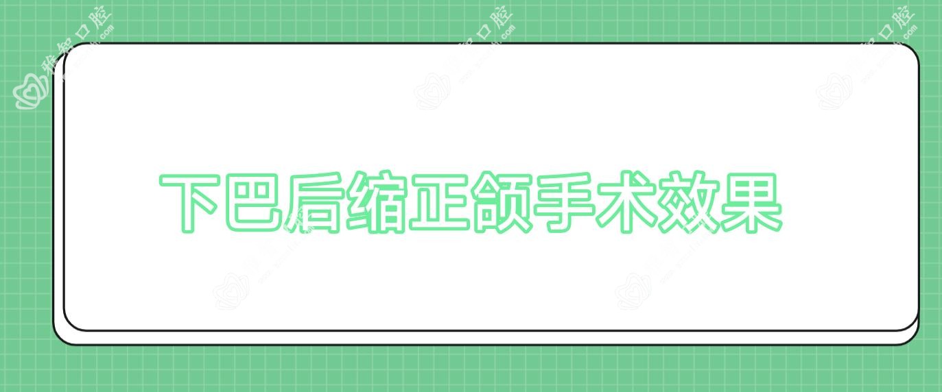 下巴后缩正颌手术疗效