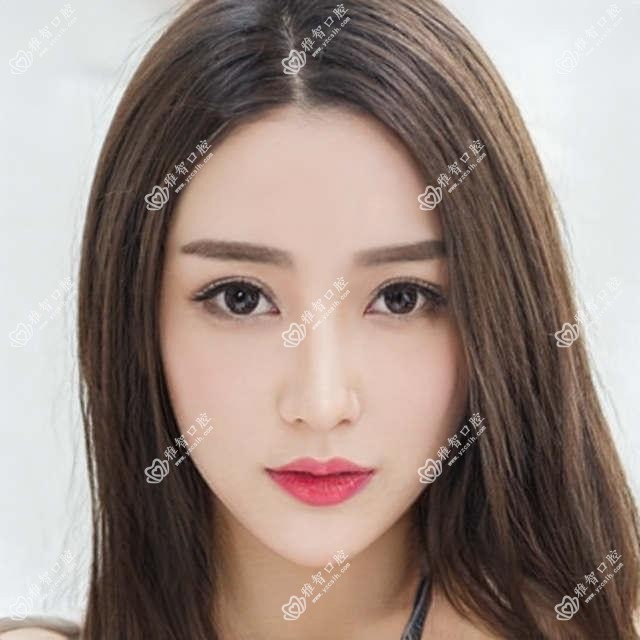 南宁收费表2025:光固化复合树脂补牙价格90元,二氧化锆全瓷牙3000元起