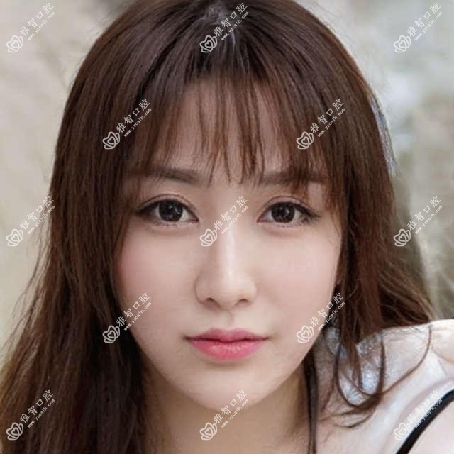 临沂氟斑牙美白2025价目表:喷砂洗牙100+茶渍牙美白400+牙齿瓷贴面1700+冷光美白500+