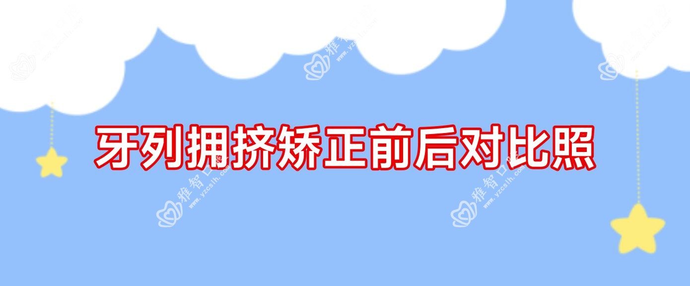 牙列拥挤矫正前后对比照