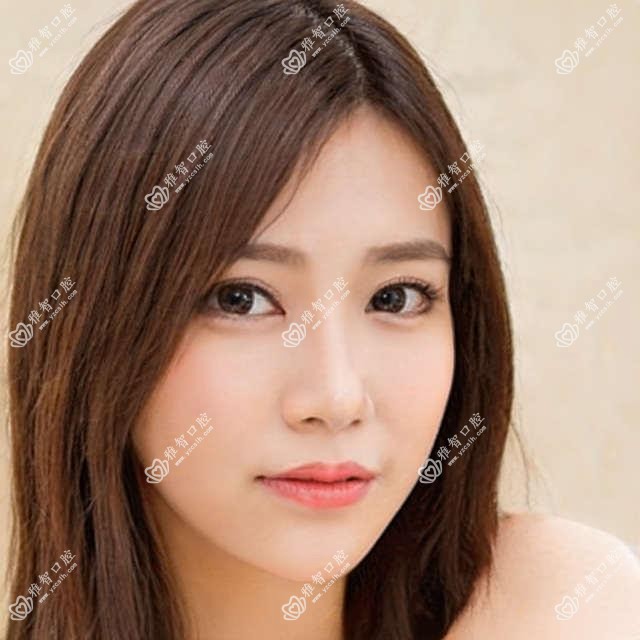 ITI种植体考虑因素有哪些 ITI种植体好转方法详解