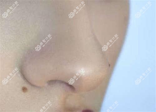 石家庄双颌前突正颌手术花多少钱?26560元可做,术前指南教你不被坑
