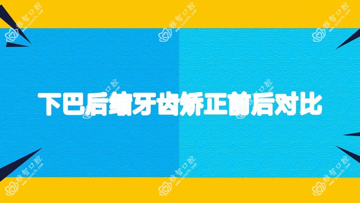 下巴后缩牙齿矫正前后对比