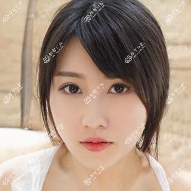 2025郑州医院12-18岁牙齿矫正标准收费单:成人牙齿矫正6k+