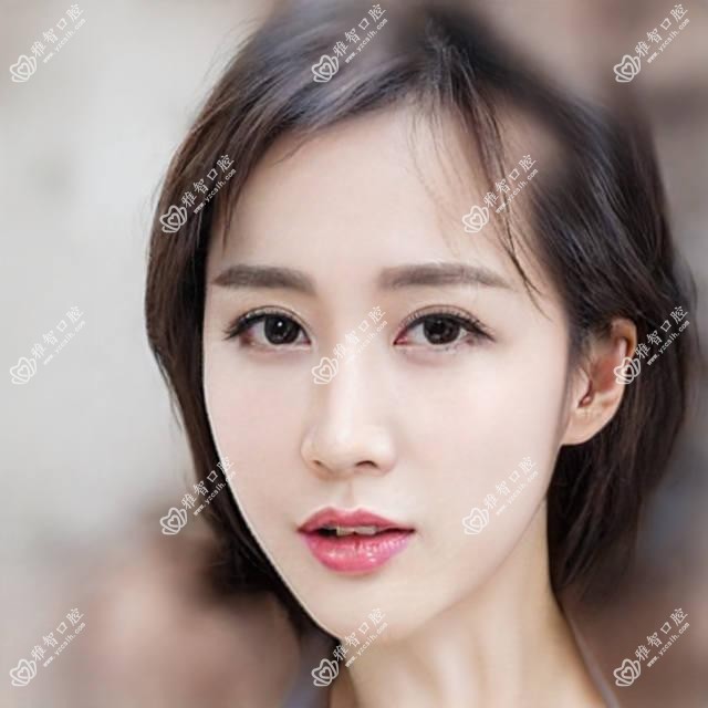 全冠牙是什么?全冠牙相关治疗优缺点以及禁忌人群?