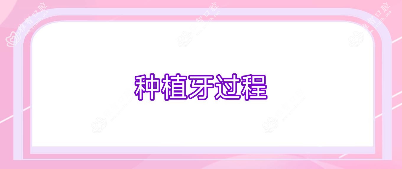 种植牙过程