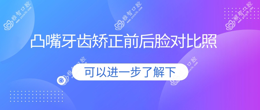 凸嘴牙齿矫正前后脸对比照