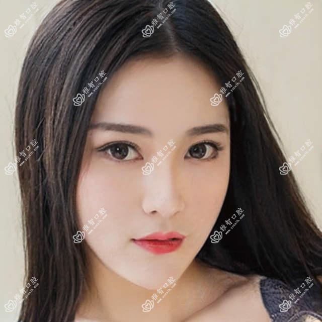 昆明喷砂洗牙多少钱?价格在100-540,四环素牙美白0.4千-7.2千