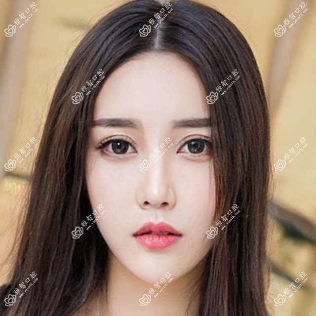 厦门透明隐形矫正收费2025年新详实揭秘-厦门海沧伍志鹏口腔科诊所/佰斯康口腔·种植矫正示范基地透明隐形矫正收费表(费用)