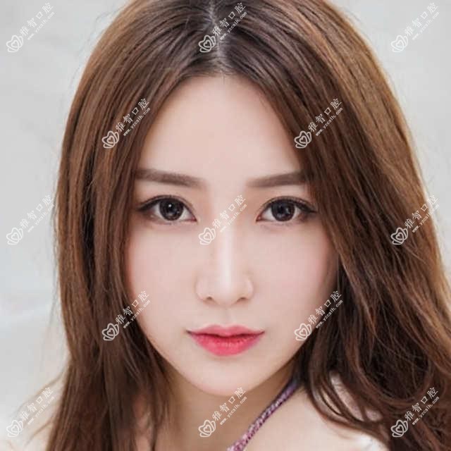 郑州半口即刻种植牙价格多少钱?2025价格表:allon6半口种植牙50000元起、半口即刻负重种植牙50000元起