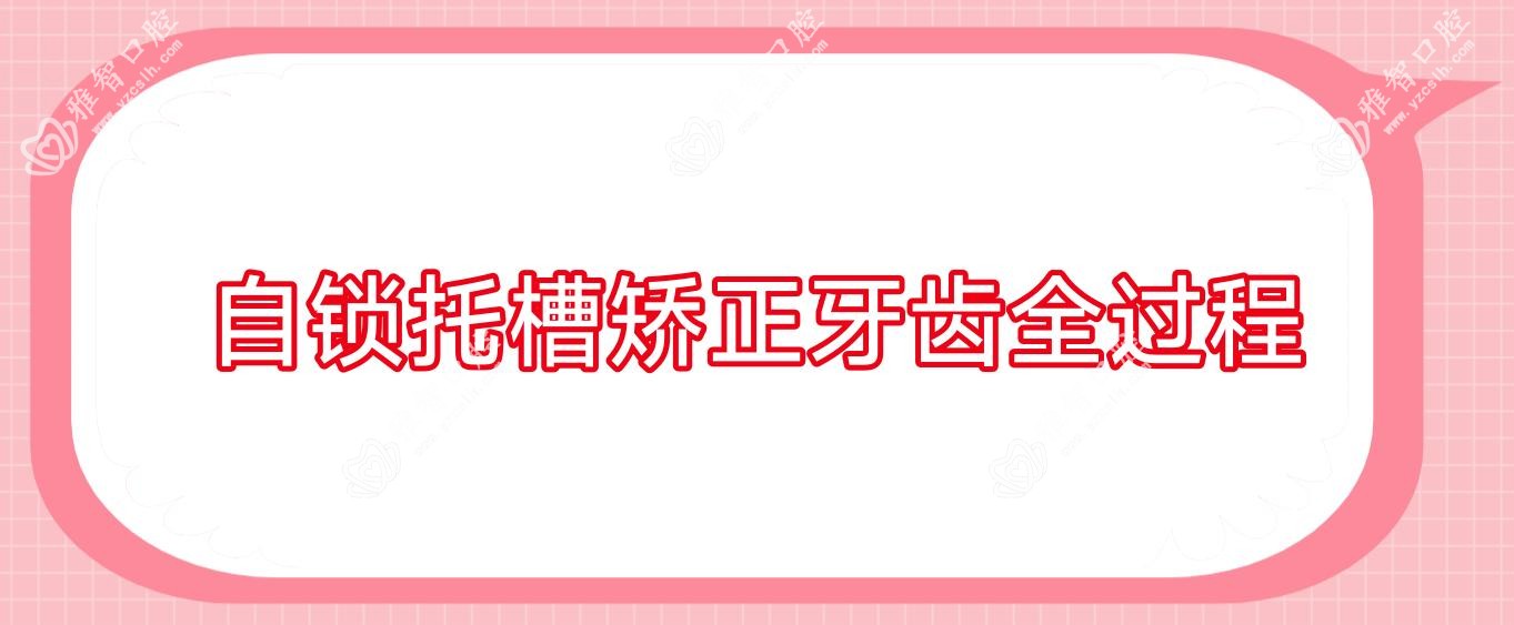 自锁托槽矫正牙齿全过程