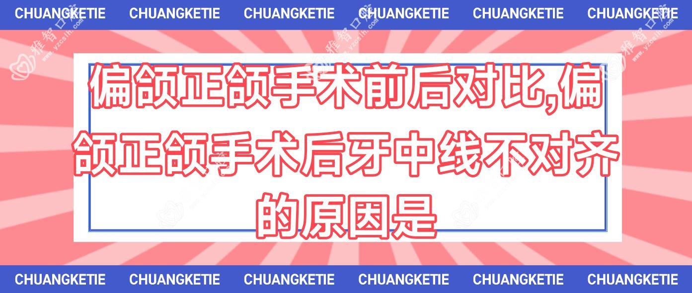 偏颌正颌手术前后对比,偏颌正颌手术后牙中线不对齐的原因是