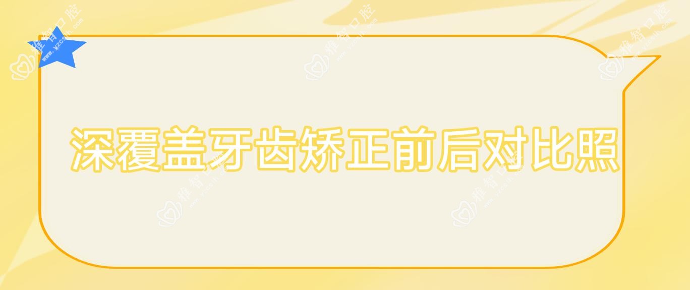 深覆盖牙齿矫正前后对比照
