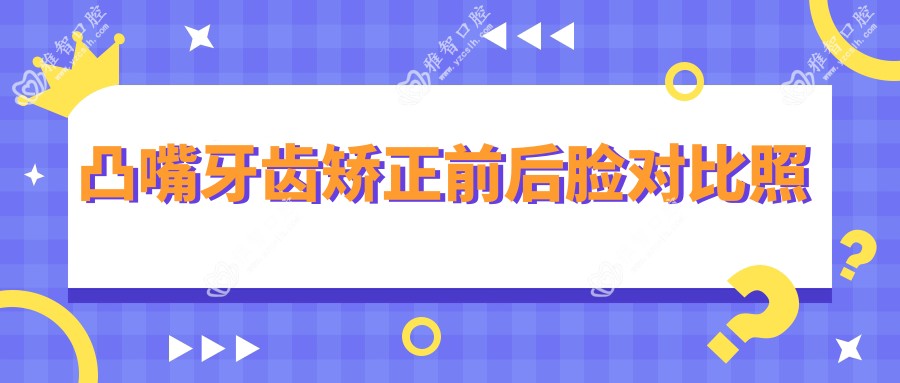 凸嘴牙齿矫正前后脸对比照