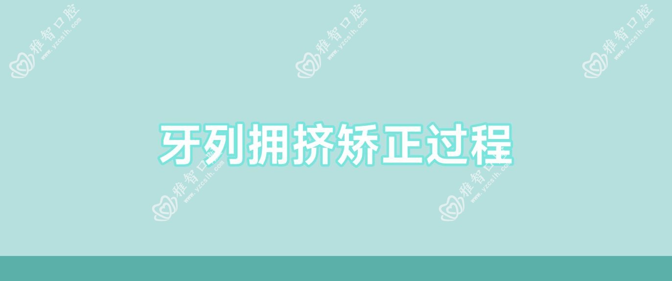 牙列拥挤矫正过程