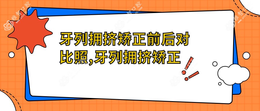 牙列拥挤矫正前后对比照,牙列拥挤矫正大概多少时间