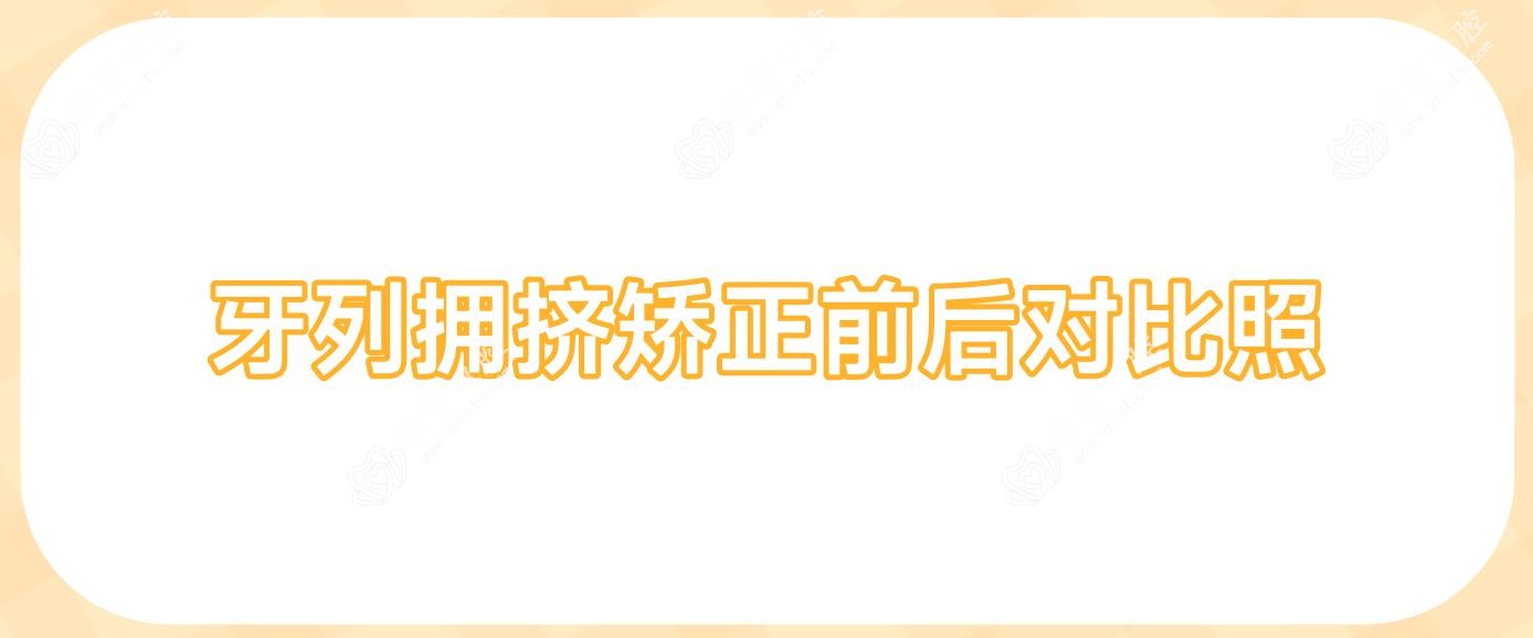 牙列拥挤矫正前后对比照