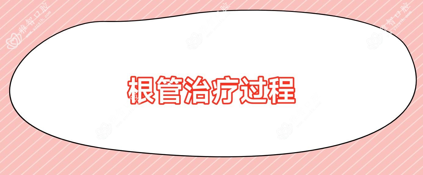 根管治疗过程