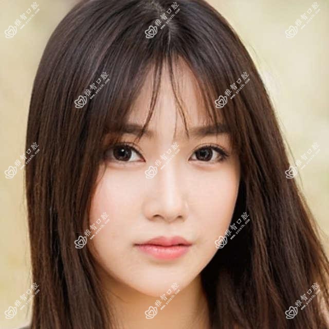 无锡深覆盖正颌手术多少钱?无锡下巴后缩正颌手术/龅牙正颌手术/脸型不对称正颌手术收费实惠