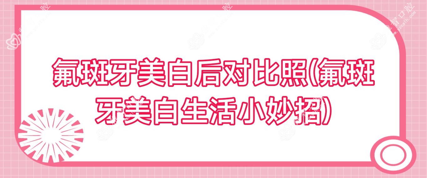 氟斑牙美白后对比照(氟斑牙美白生活小妙招)