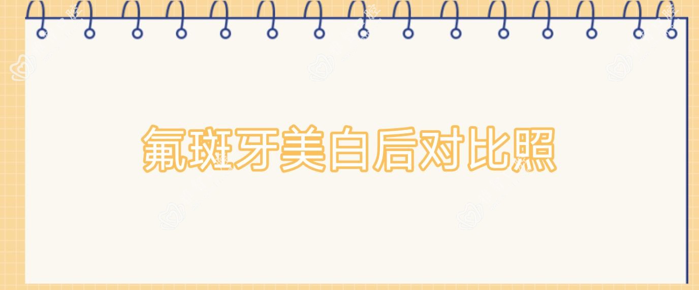 氟斑牙美白后对比照
