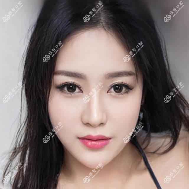 无锡双颌前突正颌手术2025价目单:下巴后缩正颌手术30000+凸嘴正颌手术40000+龅牙正颌手术30000+地包天正颌手术120000+
