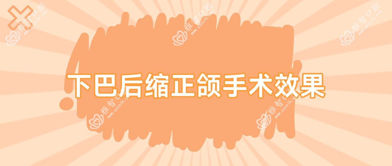 下巴后缩正颌手术疗效
