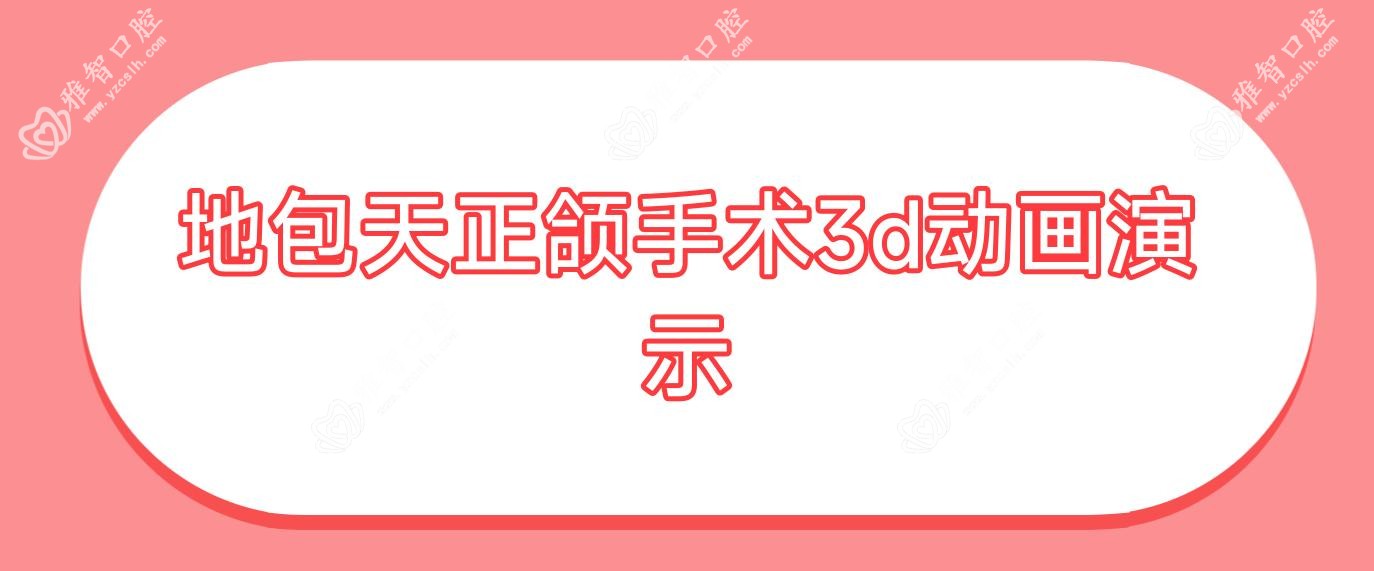 地包天正颌手术3d动画演示