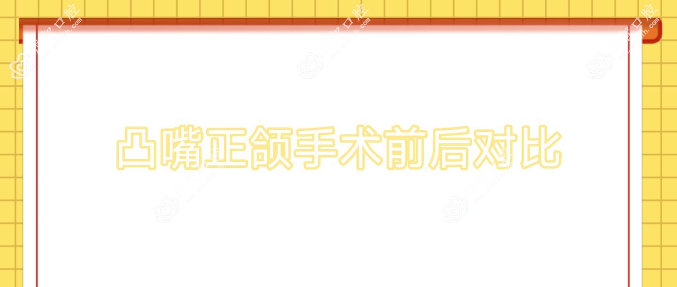 凸嘴正颌手术前后对比