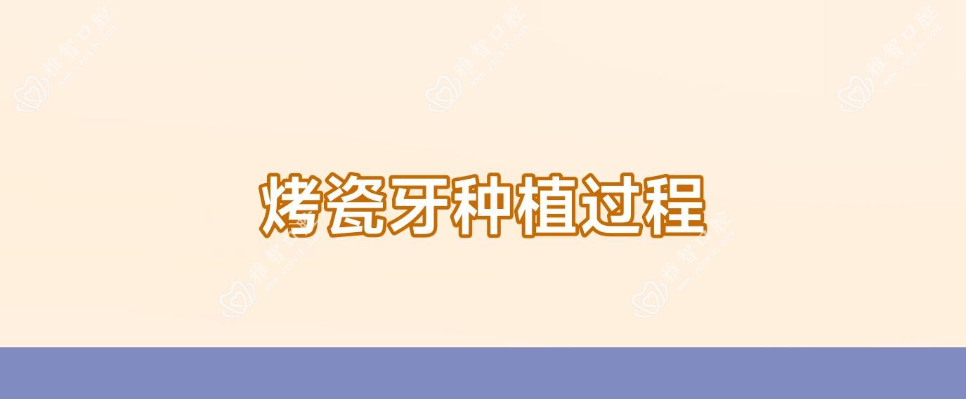 烤瓷牙种植过程