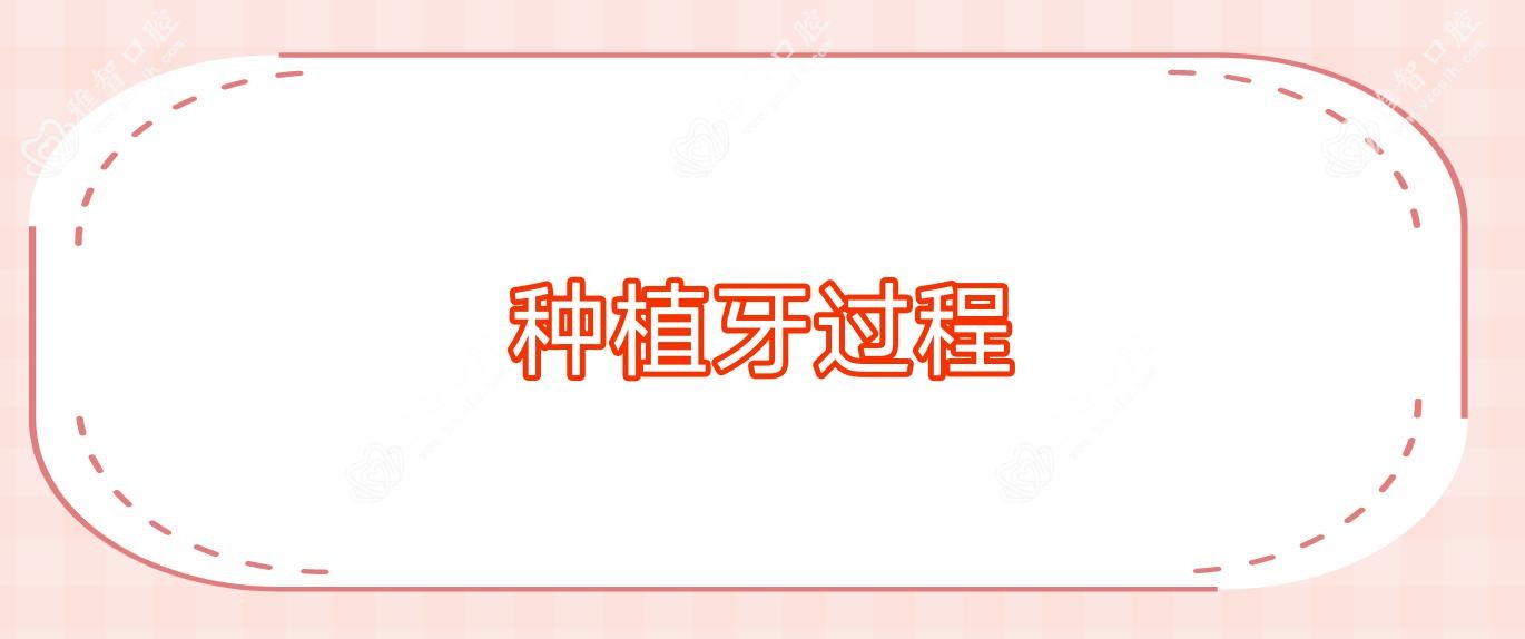 种植牙过程