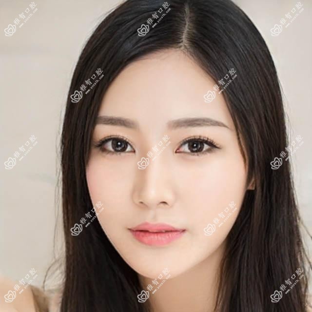 舌侧矫正你知道多少?舌侧矫正相关操作详细介绍?