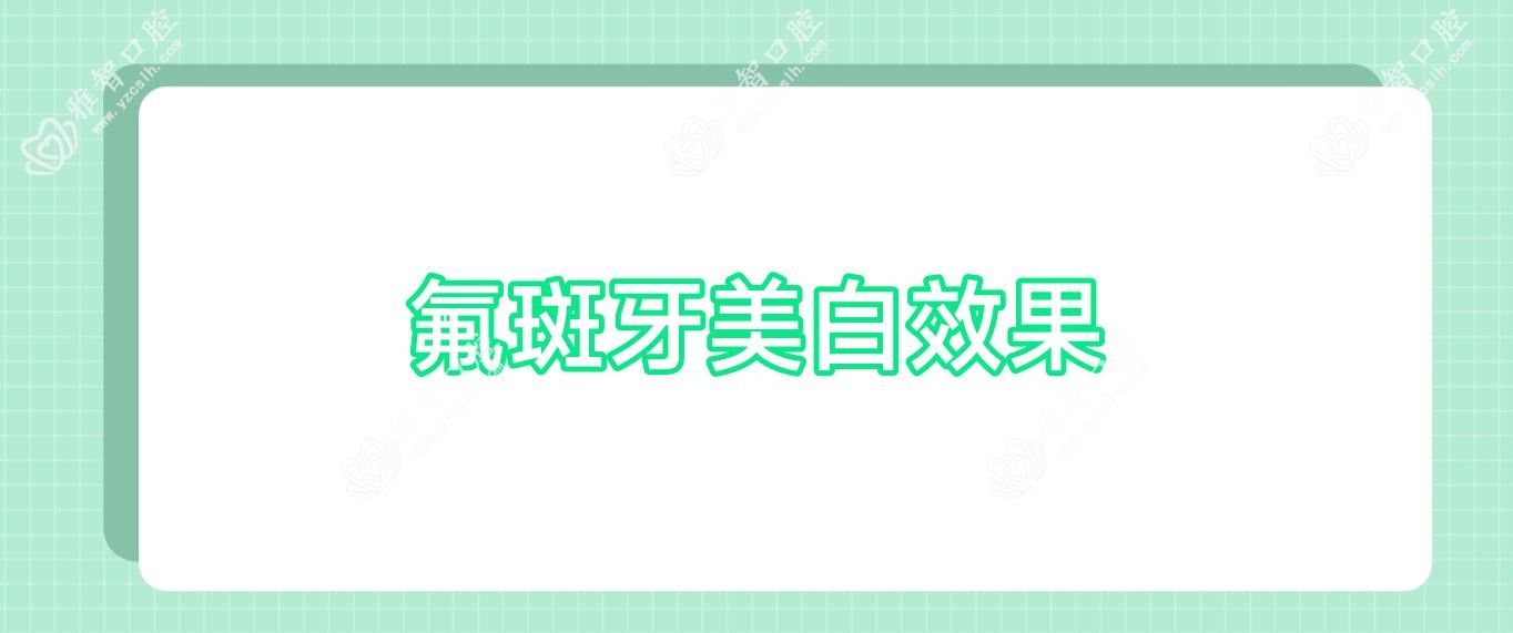 氟斑牙美白疗效