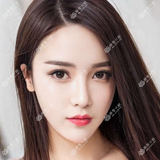 昆明allon4全口种植牙多少钱?本地推荐医院分享