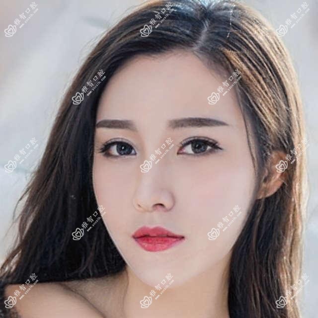 西安氟斑牙美白多少钱?价格在320-2280,咖啡牙美白0.4k-2.2k